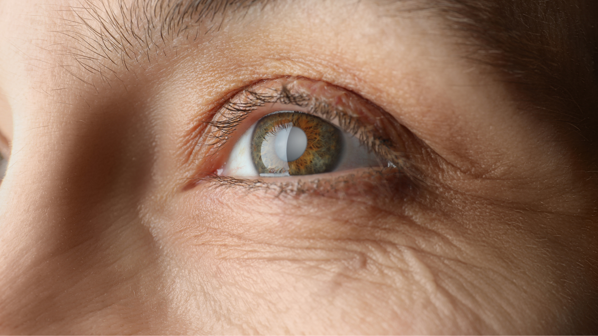 Cataracts