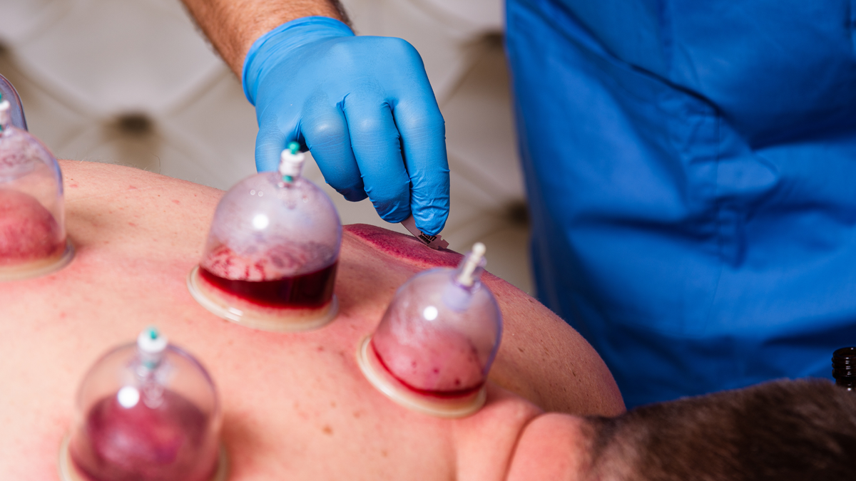 Hijama Therapy